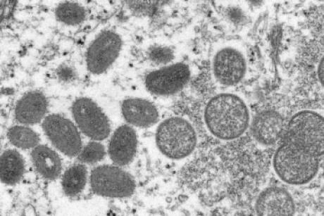 英国报告首例猴痘病毒新变种感染病例